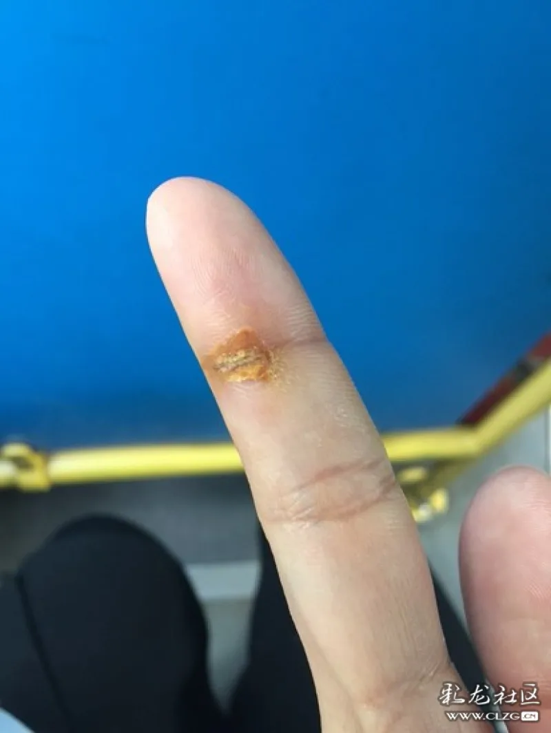 衰!手指被玻璃窗夹伤了