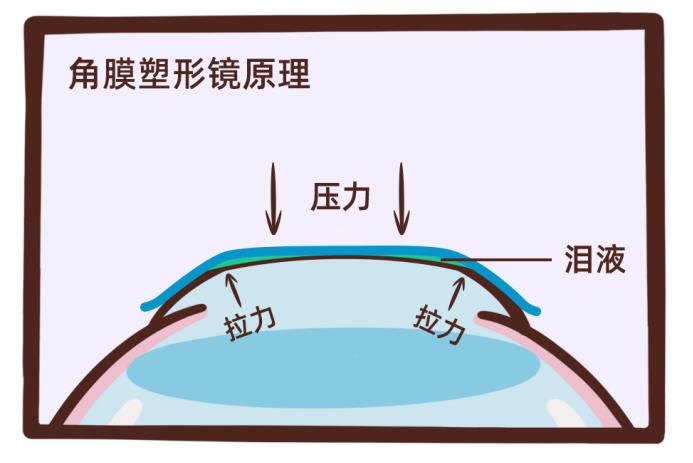 康康百問·第33期 | 角膜塑形鏡必須戴夠8小時才有效嗎?為什麼?-彩龍